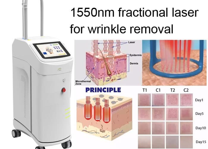 non Ablative Wrinkle Laser Machine